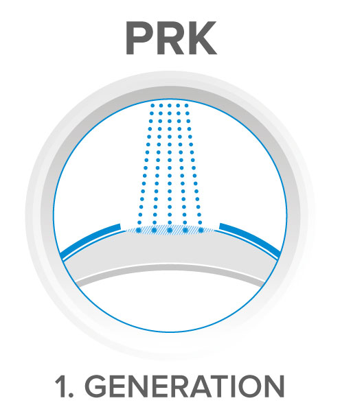 PRK - excimer laser