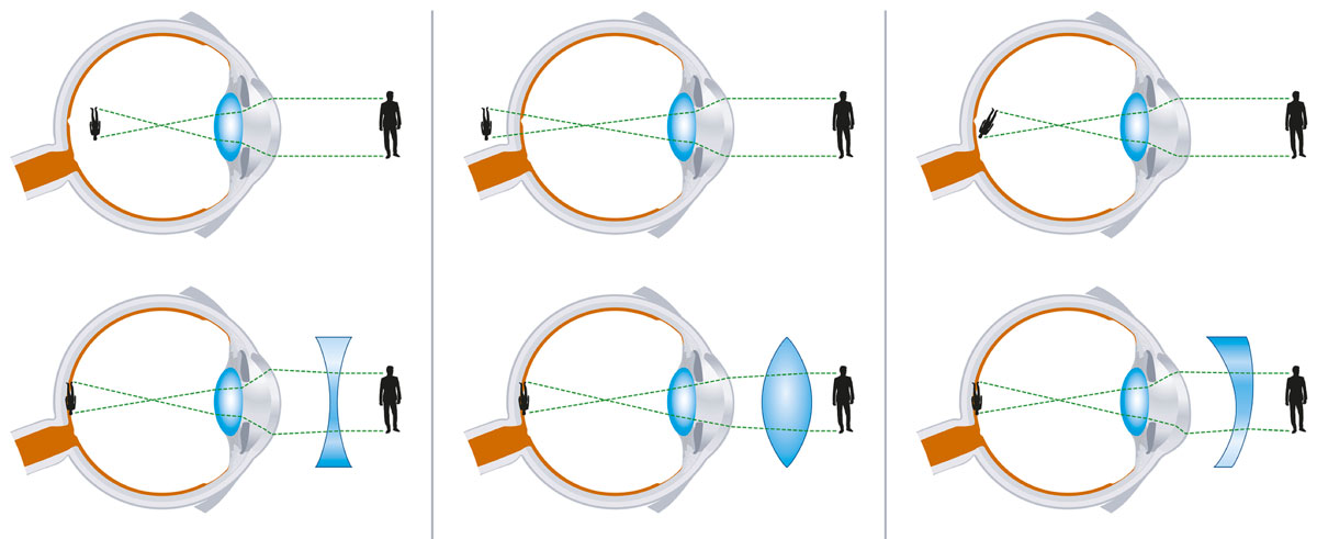 myopie astigmatismus presbyopie látás nőknél 45 után